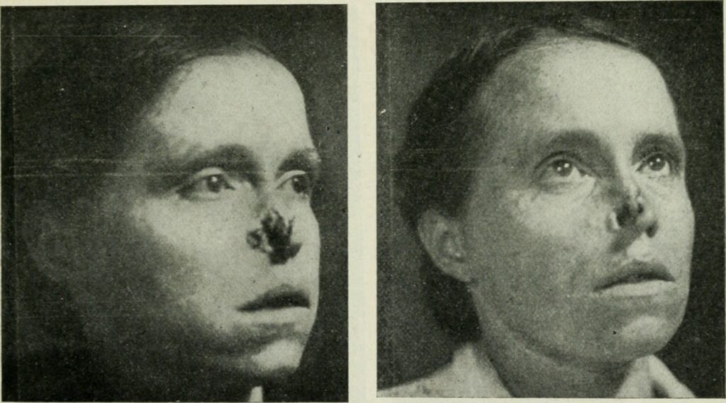 Radium Girl mit zerstörter Nase